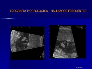 DTFRC-2007 ECOGRAFIA MORFOLOGICA  HALLAZGOS FRECUENTES   