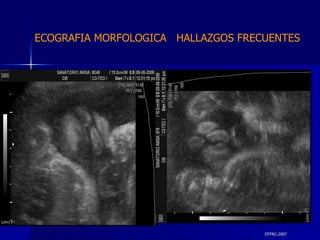 DTFRC-2007 ECOGRAFIA MORFOLOGICA  HALLAZGOS FRECUENTES   