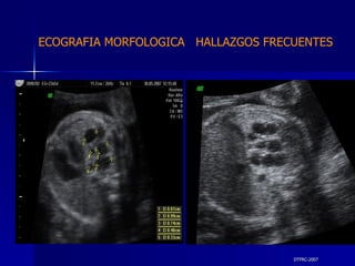 DTFRC-2007 ECOGRAFIA MORFOLOGICA  HALLAZGOS FRECUENTES   