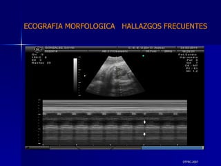 DTFRC-2007 ECOGRAFIA MORFOLOGICA  HALLAZGOS FRECUENTES   