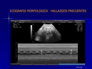 DTFRC-2007 ECOGRAFIA MORFOLOGICA  HALLAZGOS FRECUENTES   