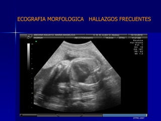 DTFRC-2007 ECOGRAFIA MORFOLOGICA  HALLAZGOS FRECUENTES   