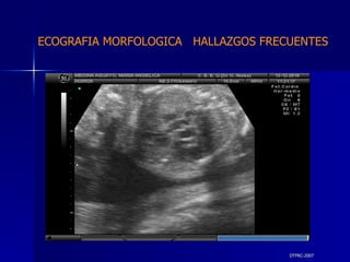 DTFRC-2007 ECOGRAFIA MORFOLOGICA  HALLAZGOS FRECUENTES   