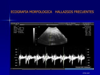 DTFRC-2007 ECOGRAFIA MORFOLOGICA  HALLAZGOS FRECUENTES   