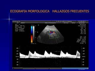 DTFRC-2007 ECOGRAFIA MORFOLOGICA  HALLAZGOS FRECUENTES   