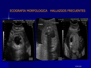 DTFRC-2007 ECOGRAFIA MORFOLOGICA  HALLAZGOS FRECUENTES   