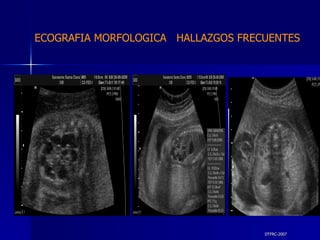 DTFRC-2007 ECOGRAFIA MORFOLOGICA  HALLAZGOS FRECUENTES   