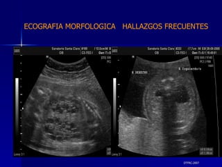 DTFRC-2007 ECOGRAFIA MORFOLOGICA  HALLAZGOS FRECUENTES   