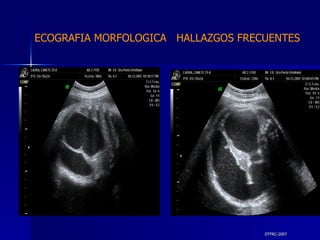 DTFRC-2007 ECOGRAFIA MORFOLOGICA  HALLAZGOS FRECUENTES   