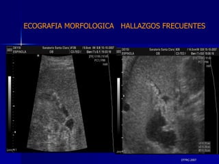 DTFRC-2007 ECOGRAFIA MORFOLOGICA  HALLAZGOS FRECUENTES   