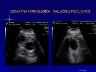 DTFRC-2007 ECOGRAFIA MORFOLOGICA  HALLAZGOS FRECUENTES   