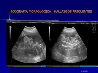 DTFRC-2007 ECOGRAFIA MORFOLOGICA  HALLAZGOS FRECUENTES   