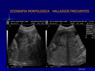 DTFRC-2007 ECOGRAFIA MORFOLOGICA  HALLAZGOS FRECUENTES   