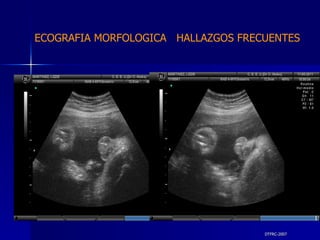 DTFRC-2007 ECOGRAFIA MORFOLOGICA  HALLAZGOS FRECUENTES   