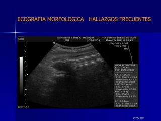 DTFRC-2007 ECOGRAFIA MORFOLOGICA  HALLAZGOS FRECUENTES   