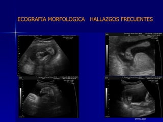 DTFRC-2007 ECOGRAFIA MORFOLOGICA  HALLAZGOS FRECUENTES   