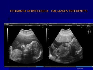 DTFRC-2007 ECOGRAFIA MORFOLOGICA  HALLAZGOS FRECUENTES   