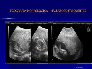 DTFRC-2007 ECOGRAFIA MORFOLOGICA  HALLAZGOS FRECUENTES   