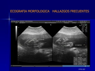 DTFRC-2007 ECOGRAFIA MORFOLOGICA  HALLAZGOS FRECUENTES   