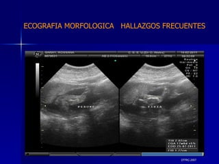 DTFRC-2007 ECOGRAFIA MORFOLOGICA  HALLAZGOS FRECUENTES   