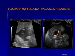 DTFRC-2007 ECOGRAFIA MORFOLOGICA  HALLAZGOS FRECUENTES   