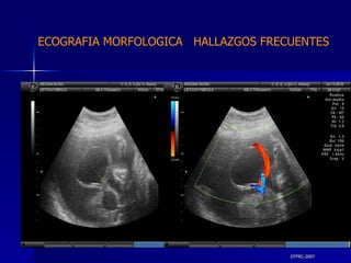 DTFRC-2007 ECOGRAFIA MORFOLOGICA  HALLAZGOS FRECUENTES   