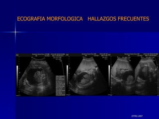 DTFRC-2007 ECOGRAFIA MORFOLOGICA  HALLAZGOS FRECUENTES   