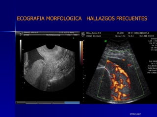 DTFRC-2007 ECOGRAFIA MORFOLOGICA  HALLAZGOS FRECUENTES   