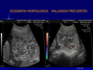 DTFRC-2007 ECOGRAFIA MORFOLOGICA  HALLAZGOS FRECUENTES   