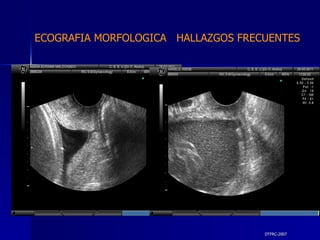 DTFRC-2007 ECOGRAFIA MORFOLOGICA  HALLAZGOS FRECUENTES   