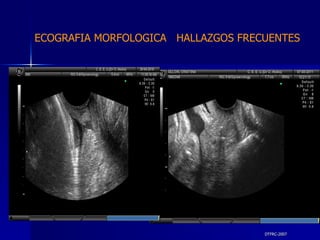 DTFRC-2007 ECOGRAFIA MORFOLOGICA  HALLAZGOS FRECUENTES   