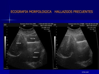 DTFRC-2007 ECOGRAFIA MORFOLOGICA  HALLAZGOS FRECUENTES   