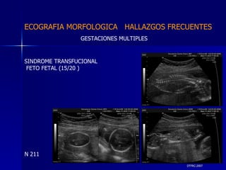 DTFRC-2007 ECOGRAFIA MORFOLOGICA  HALLAZGOS FRECUENTES   GESTACIONES MULTIPLES  N 211 SINDROME TRANSFUCIONAL FETO FETAL (15/20 ) 