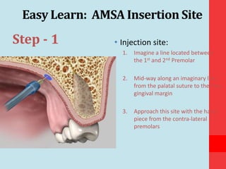 Mid Palatal Injection Original prevention remineralization resoration 2013 | PPTX