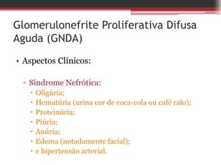 Glomerulonefrite Proliferativa Difusa
Aguda (GNDA)
• Aspectos Clínicos:
 