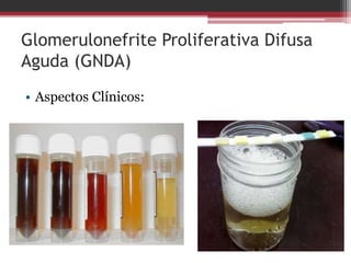 Glomerulonefrite Rapidamente
Progressiva (GNRP)
• Formação de crescentes
 