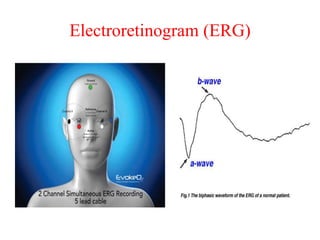 Electroretinogram (ERG)
 