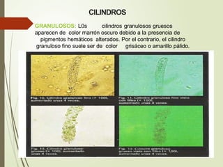 GRANULOSOS: L0s cilindros granulosos gruesos
aparecen de color marrón oscuro debido a la presencia de
pigmentos hemáticos alterados. Por el contrario, el cilindro
granuloso fino suele ser de color grisáceo o amarillo pálido.
CILINDROS
 