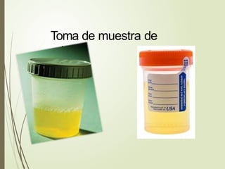 Toma de muestra de
orina
 