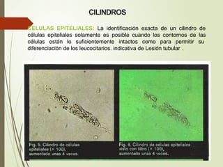 CELULAS EPITELIALES: La identificación exacta de un cilindro de
células epiteliales solamente es posible cuando los contornos de las
células están lo suficientemente intactos como para permitir su
diferenciación de los leucocitarios. indicativa de Lesión tubular .
CILINDROS
 
