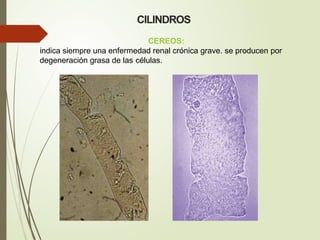 CILINDROS
CEREOS:
indica siempre una enfermedad renal crónica grave. se producen por
degeneración grasa de las células.
 