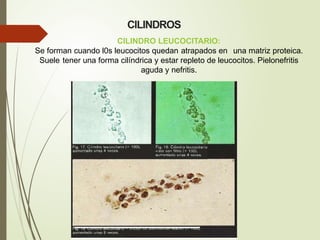 CILINDRO LEUCOCITARIO:
Se forman cuando l0s leucocitos quedan atrapados en una matriz proteica.
Suele tener una forma cilíndrica y estar repleto de leucocitos. Pielonefritis
aguda y nefritis.
CILINDROS
 