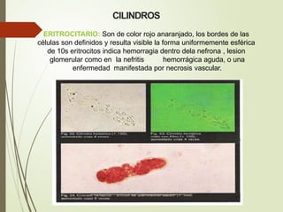 CILINDROS
ERITROCITARIO: Son de color rojo anaranjado, los bordes de las
células son definidos y resulta visible la forma uniformemente esférica
de 10s eritrocitos indica hemorragia dentro dela nefrona , lesion
glomerular como en la nefritis hemorrágica aguda, o una
enfermedad manifestada por necrosis vascular.
 