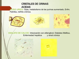 CRISTALES DE ORINAS
ACIDAS
ACIDO URICO: Gota, metabolismo de las purinas aumentado, Enfm.
Febriles, nefritis crónica.
OXALATO DE CALCIO: Intoxicación con etilenglicol, Diabetes Mellitus,
Enfermedad hepática y renal crónica
 