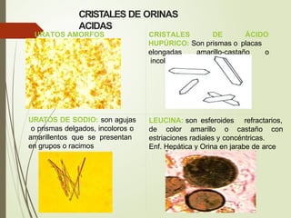 CRISTALES DE ORINAS
ACIDAS
URATOS AMORFOS CRISTALES DE ÁCIDO
HUPÚRICO: Son prismas o placas
amarillo-castaño o
elongadas
incolo
ra
s
URATOS DE SODIO: son agujas
o prismas delgados, incoloros o
amarillentos que se presentan
en grupos o racimos
LEUCINA: son esferoides refractarios,
de color amarillo o castaño con
estriaciones radiales y concéntricas.
Enf. Hepática y Orina en jarabe de arce
 