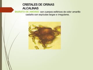 CRISTALES DE ORINAS
ALCALINAS
BIURATO DE AMONIO: son cuerpos esféricos de color amarillo
castaño con espículas largas e irregulares.
 