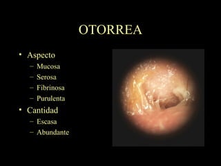 OTORREA Aspecto Mucosa Serosa Fibrinosa Purulenta Cantidad Escasa Abundante 