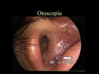 Otoscopía 