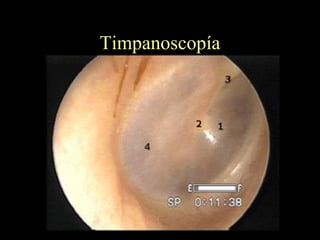 Timpanoscopía 