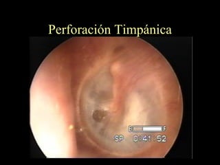 Perforación Timpánica 